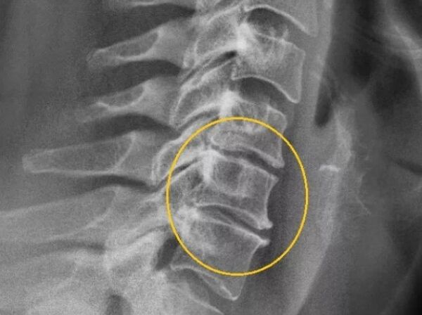 Osteochondrose der Halswirbelsäule auf einem X -Strahlen