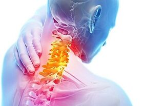 Ursachen für zervikale Osteochondrose