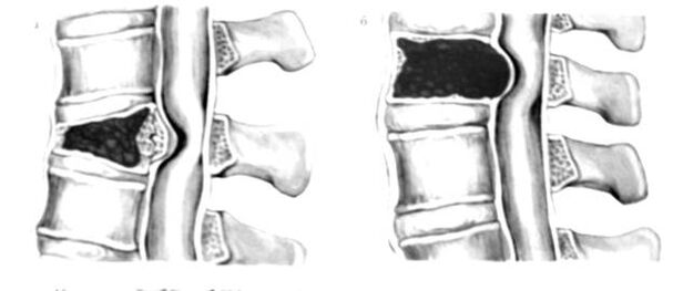 Der Tumor in der Wirbelsäule ist die Ursache von Rückenschmerzen